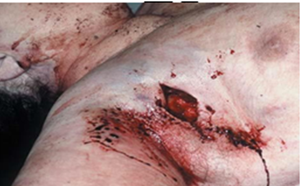 Atypical slit-like exit wound of a homicidal firearm wound from a hunting rifle with entrance wound in the back.